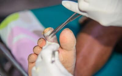 Chiropractors Treating Diabetic Foot Ulcers?